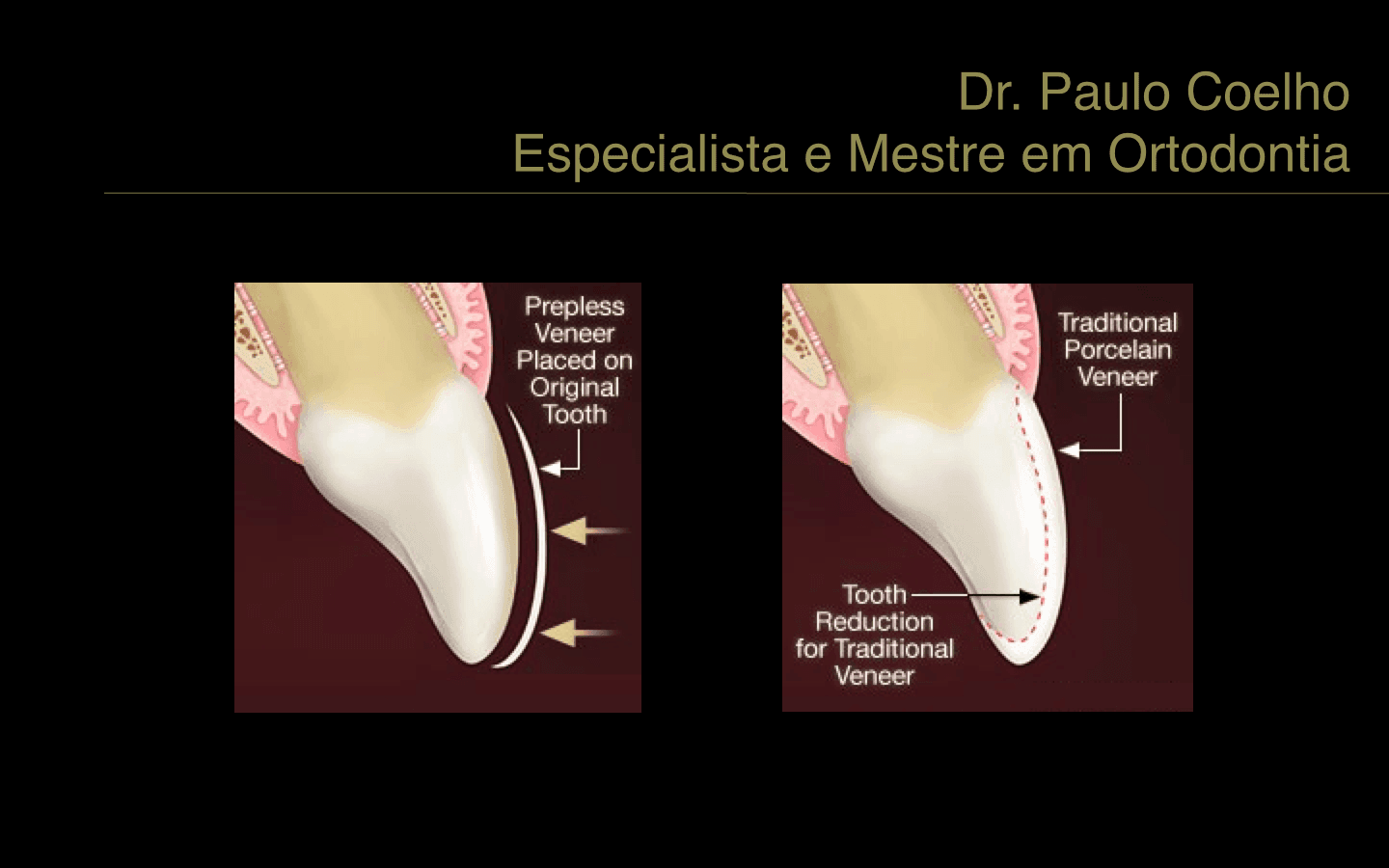 Faceta e Lente de contato dental Faceta e Lente de contato dental