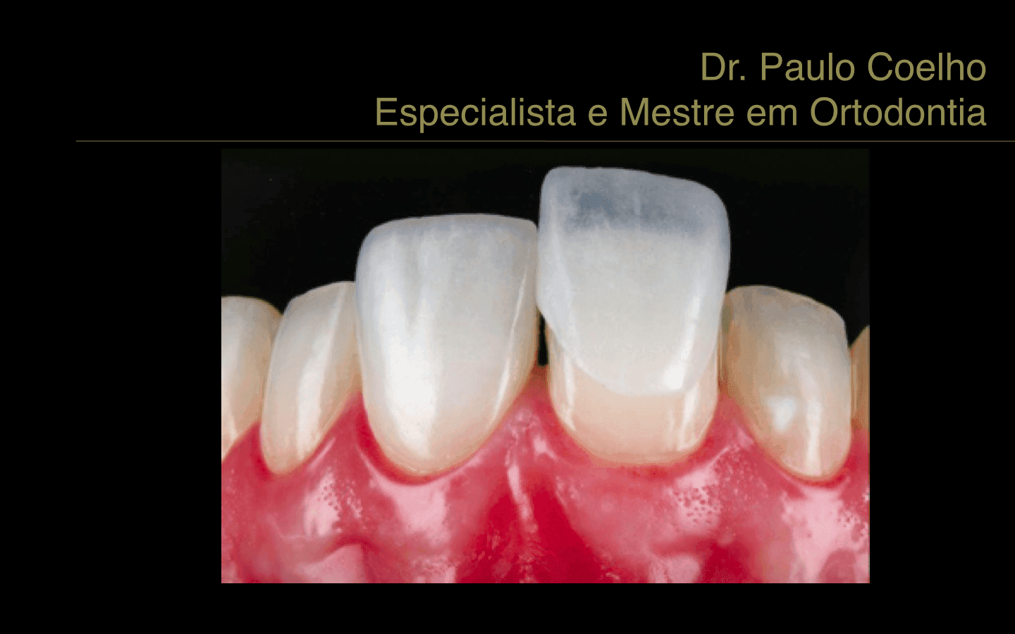Facetas-e-lente-de-contato-dental-2 Facetas-e-lente-de-contato-dental-2