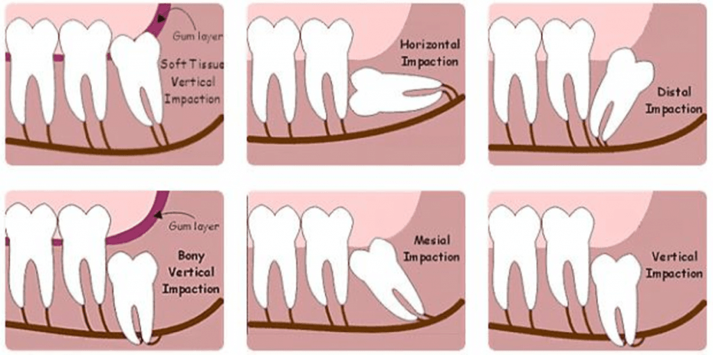 Dente do Siso Nascendo, Deitado e Inflamado Socorro Dr Paulo Coelho
