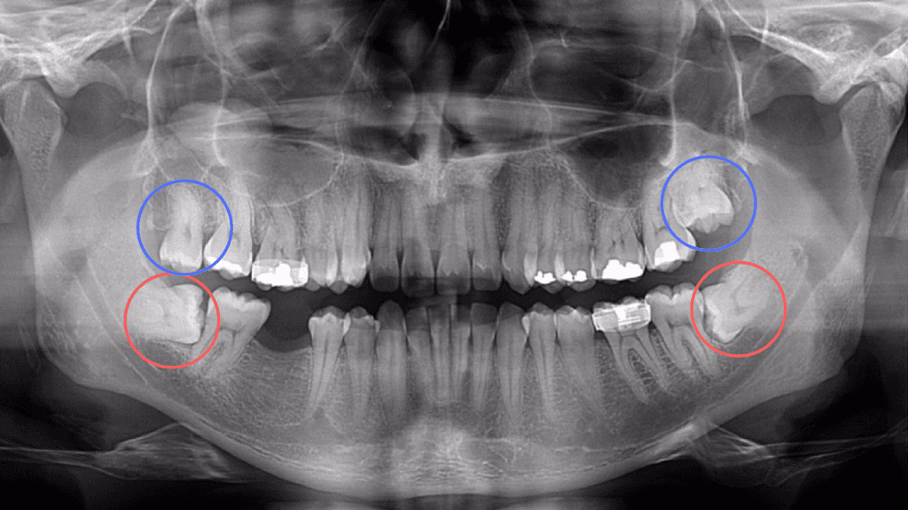 Sofrendo com Dor no Dente do Siso? Veja as Melhores Opções de Tratamento