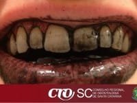 Whitemax funciona? Saiba tudo sobre Clareamento Dental