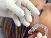 Alinhador Transparente Esthetic Aligner em Campinas e São Paulo