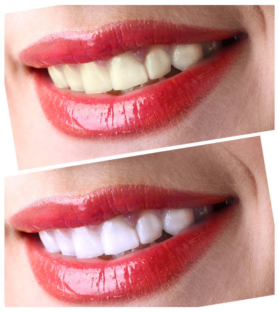 Lente de contato dental antes e depois